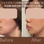 フェイスラインの厚みが取れない原因を美容鍼と脂肪溶解の視点から解説した記事のアイキャッチ画像